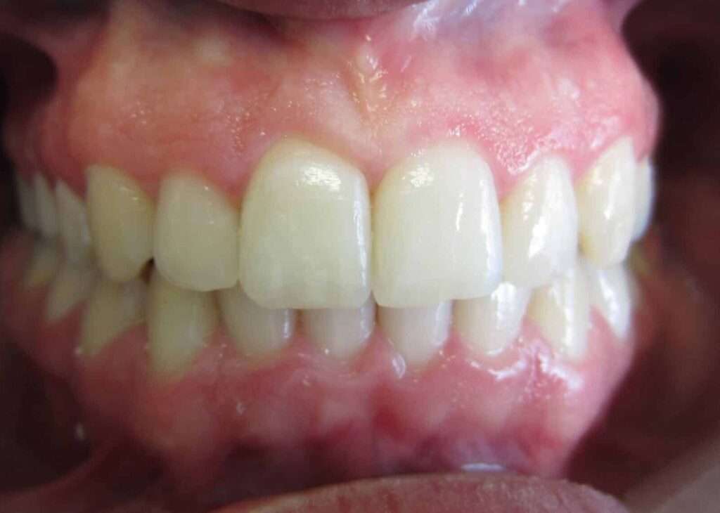 Smile Gallery. Dentist in Laguna Hills, CA. Dr. Marian Bradford, DDS. Premier Dental of South Orange County