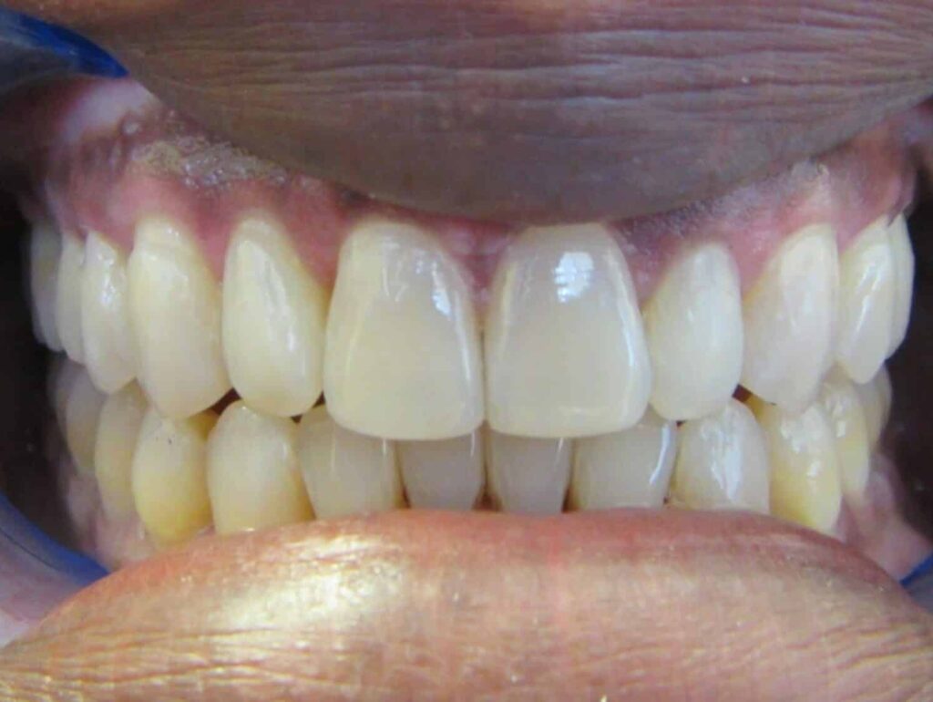 Smile Gallery. Dentist in Laguna Hills, CA. Dr. Marian Bradford, DDS. Premier Dental of South Orange County