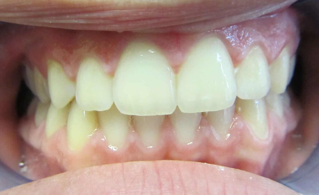 Smile Gallery. Dentist in Laguna Hills, CA. Dr. Marian Bradford, DDS. Premier Dental of South Orange County