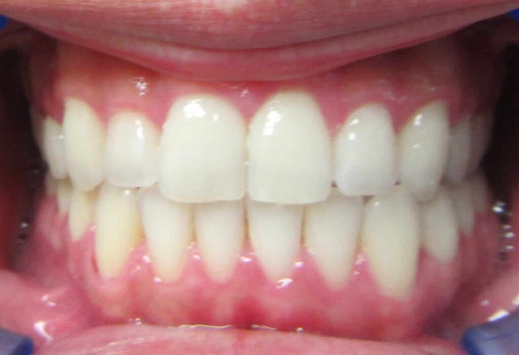 Smile Gallery. Dentist in Laguna Hills, CA. Dr. Marian Bradford, DDS. Premier Dental of South Orange County