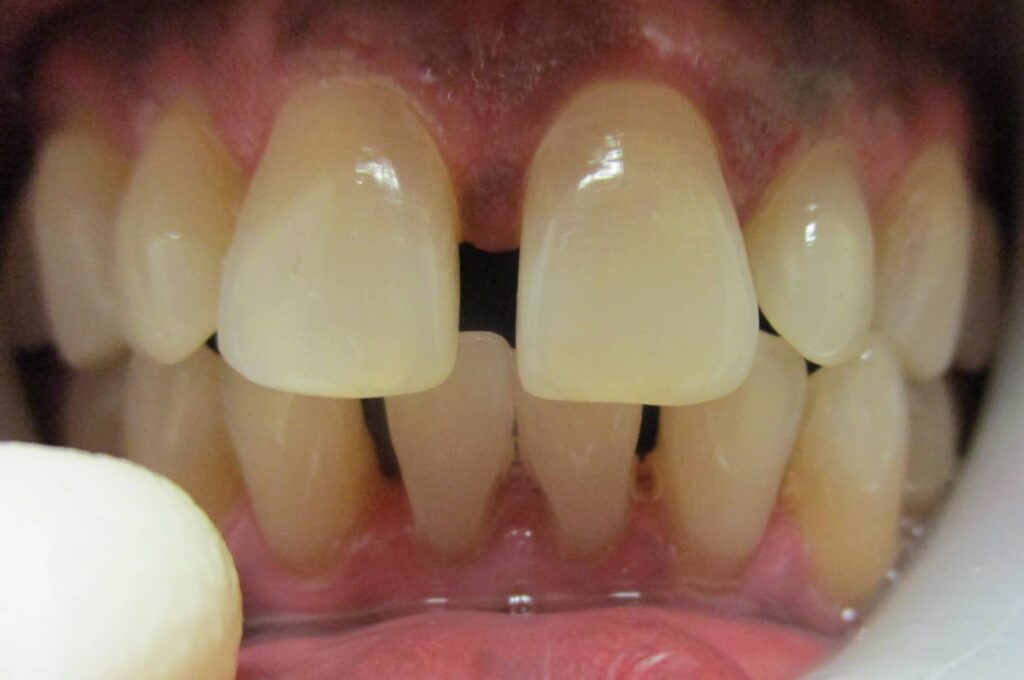 Smile Gallery. Dentist in Laguna Hills, CA. Dr. Marian Bradford, DDS. Premier Dental of South Orange County