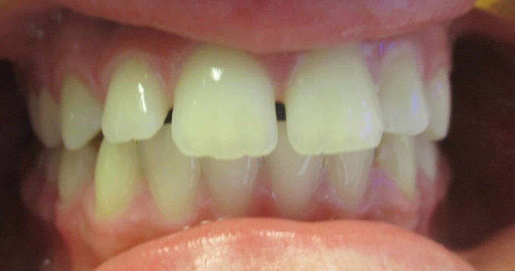 Smile Gallery. Dentist in Laguna Hills, CA. Dr. Marian Bradford, DDS. Premier Dental of South Orange County