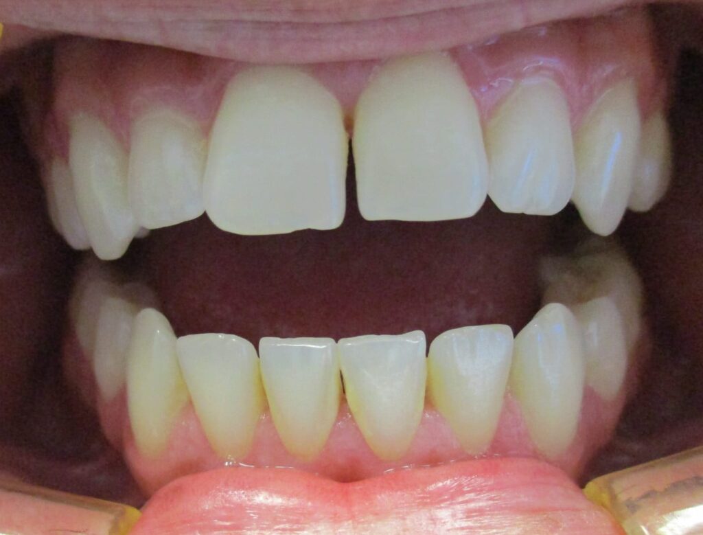 Smile Gallery. Dentist in Laguna Hills, CA. Dr. Marian Bradford, DDS. Premier Dental of South Orange County