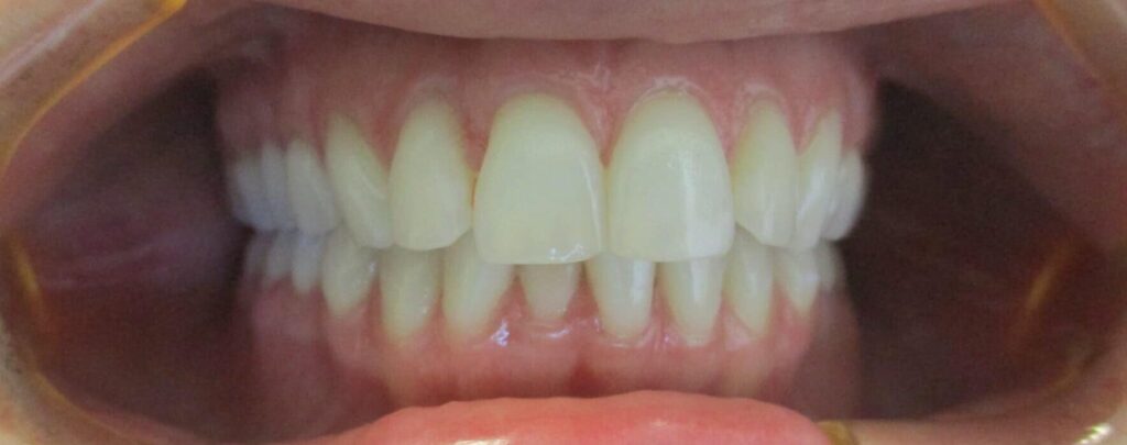 Smile Gallery. Dentist in Laguna Hills, CA. Dr. Marian Bradford, DDS. Premier Dental of South Orange County