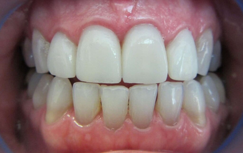 Smile Gallery. Dentist in Laguna Hills, CA. Dr. Marian Bradford, DDS. Premier Dental of South Orange County