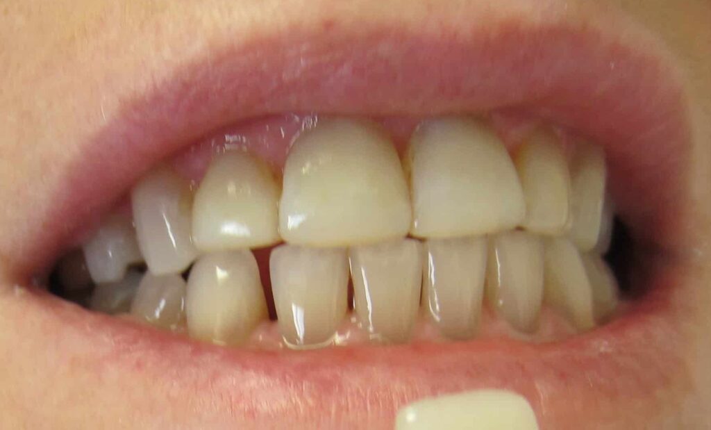 Smile Gallery. Dentist in Laguna Hills, CA. Dr. Marian Bradford, DDS. Premier Dental of South Orange County
