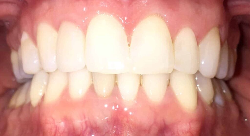 Smile Gallery. Dentist in Laguna Hills, CA. Dr. Marian Bradford, DDS. Premier Dental of South Orange County