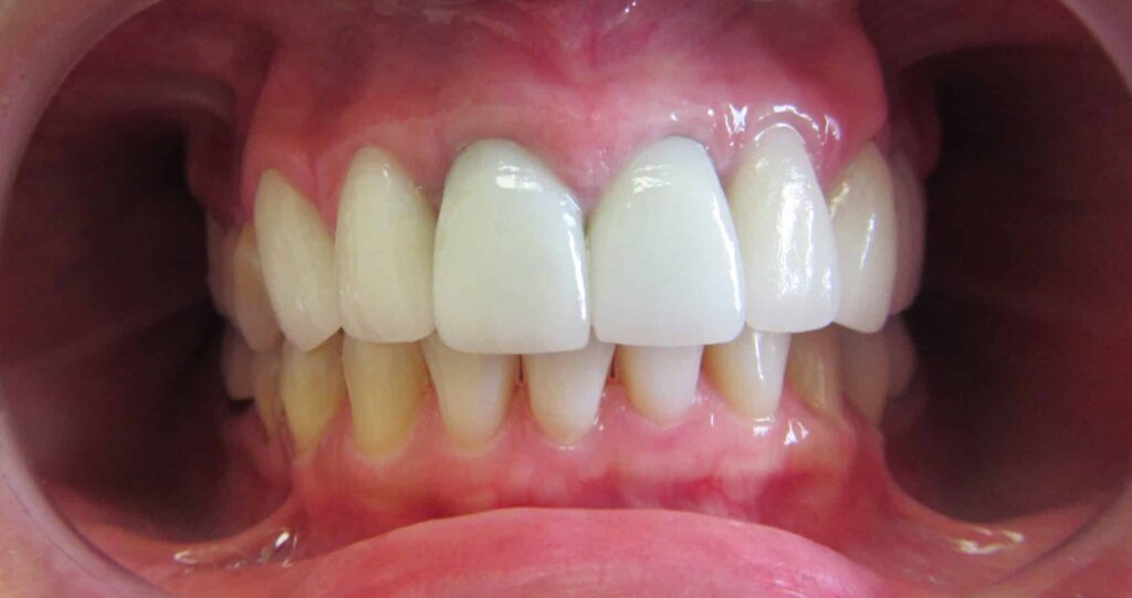 Smile Gallery. Dentist in Laguna Hills, CA. Dr. Marian Bradford, DDS. Premier Dental of South Orange County