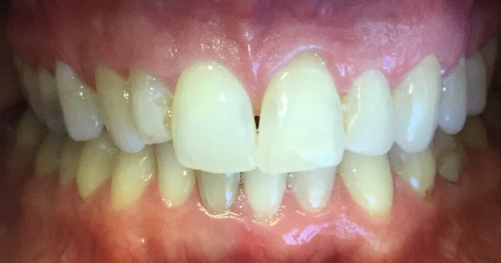 Smile Gallery. Dentist in Laguna Hills, CA. Dr. Marian Bradford, DDS. Premier Dental of South Orange County