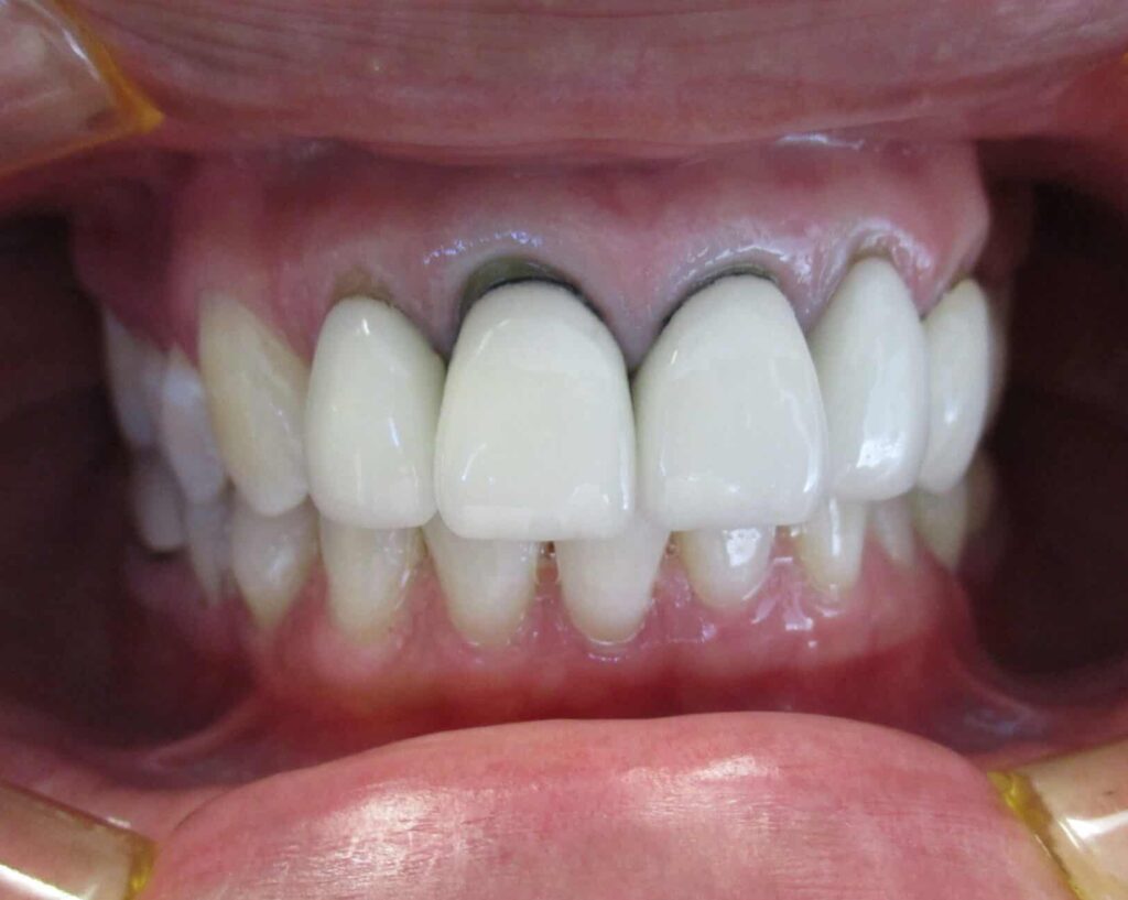 Smile Gallery. Dentist in Laguna Hills, CA. Dr. Marian Bradford, DDS. Premier Dental of South Orange County