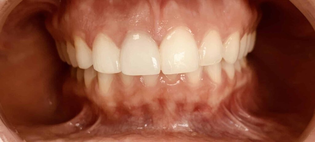Smile Gallery. Dentist in Laguna Hills, CA. Dr. Marian Bradford, DDS. Premier Dental of South Orange County