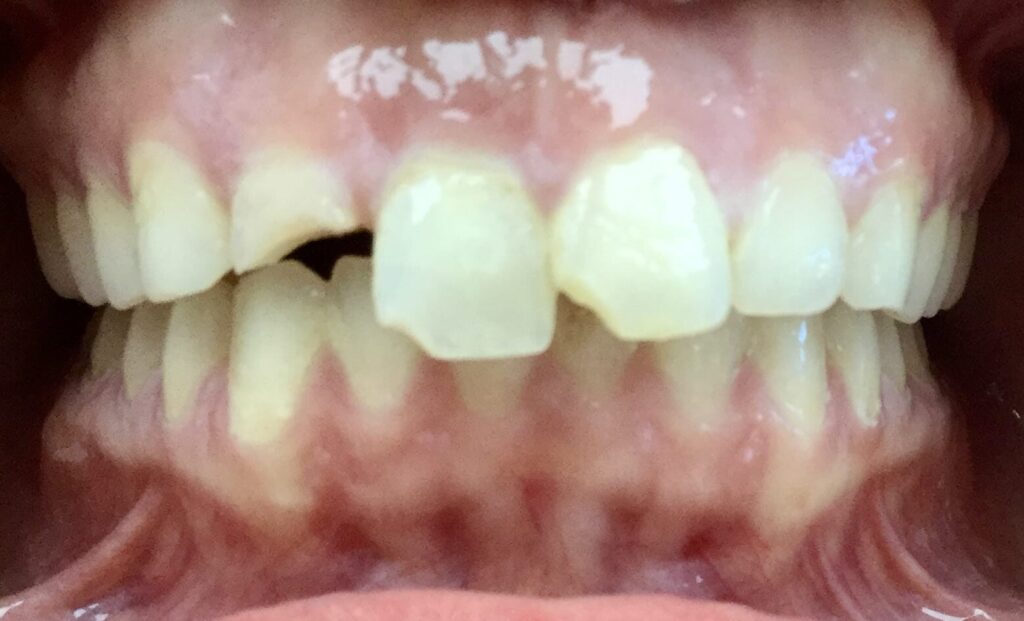 Smile Gallery. Dentist in Laguna Hills, CA. Dr. Marian Bradford, DDS. Premier Dental of South Orange County
