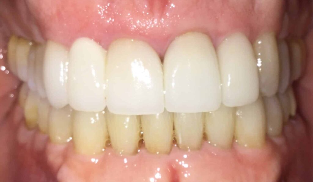 Smile Gallery. Dentist in Laguna Hills, CA. Dr. Marian Bradford, DDS. Premier Dental of South Orange County