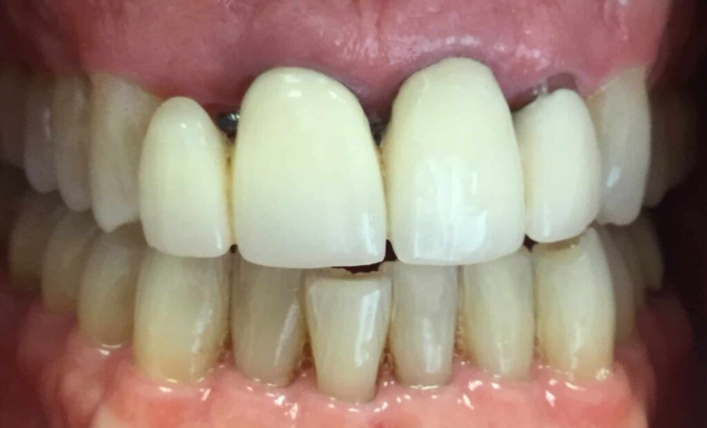 Smile Gallery. Dentist in Laguna Hills, CA. Dr. Marian Bradford, DDS. Premier Dental of South Orange County