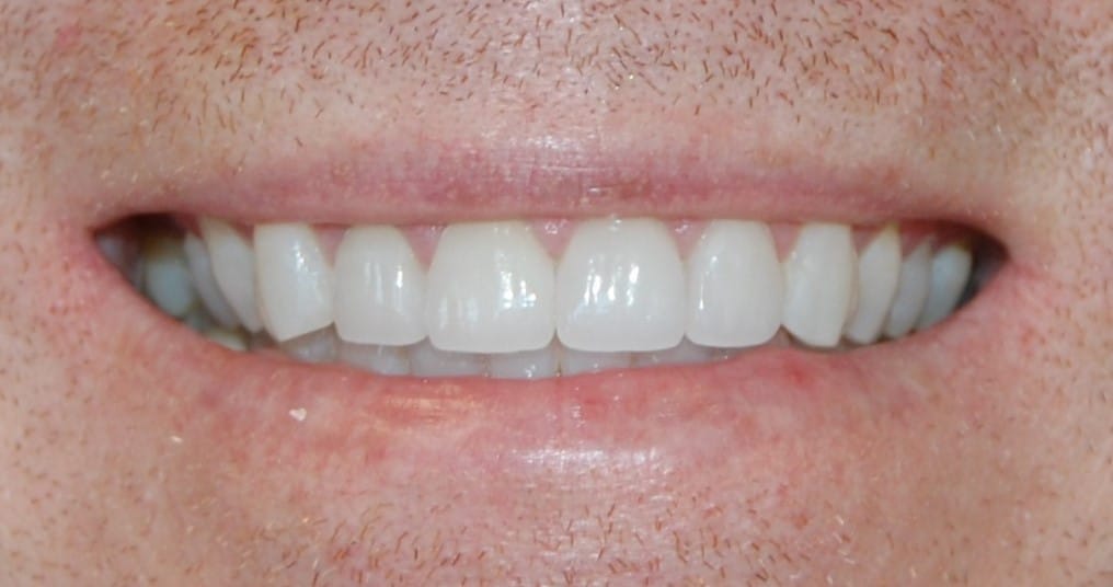 Smile Gallery. Dentist in Laguna Hills, CA. Dr. Marian Bradford, DDS. Premier Dental of South Orange County