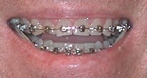 Smile Gallery. Dentist in Laguna Hills, CA. Dr. Marian Bradford, DDS. Premier Dental of South Orange County