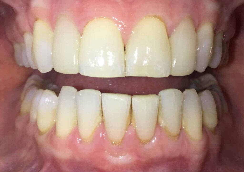 Smile Gallery. Dentist in Laguna Hills, CA. Dr. Marian Bradford, DDS. Premier Dental of South Orange County