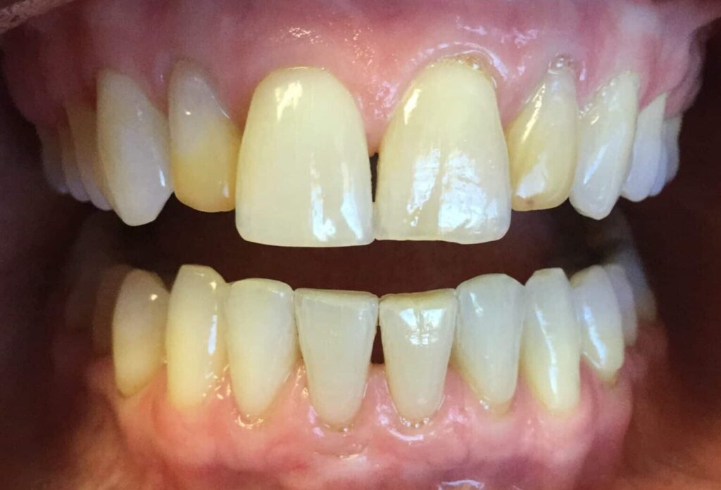 Smile Gallery. Dentist in Laguna Hills, CA. Dr. Marian Bradford, DDS. Premier Dental of South Orange County