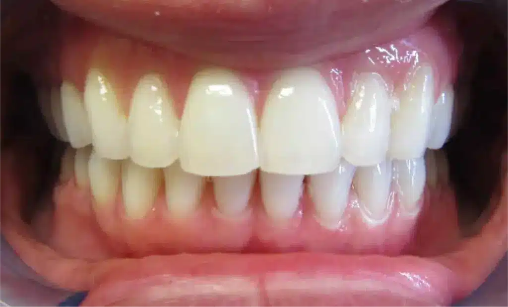 Smile Gallery. Dentist in Laguna Hills, CA. Dr. Marian Bradford, DDS. Premier Dental of South Orange County