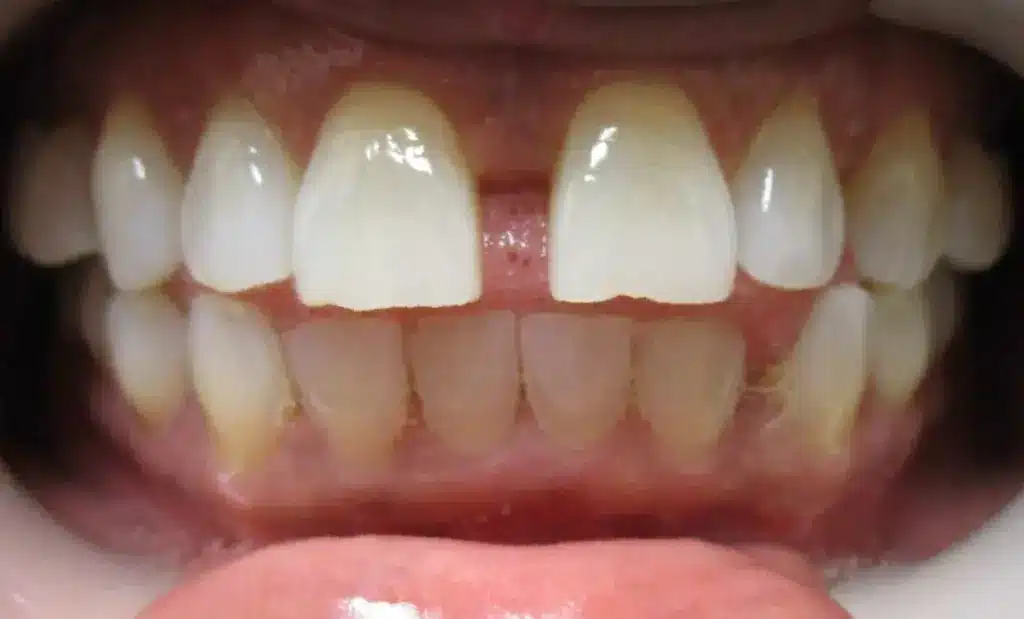 Smile Gallery. Dentist in Laguna Hills, CA. Dr. Marian Bradford, DDS. Premier Dental of South Orange County