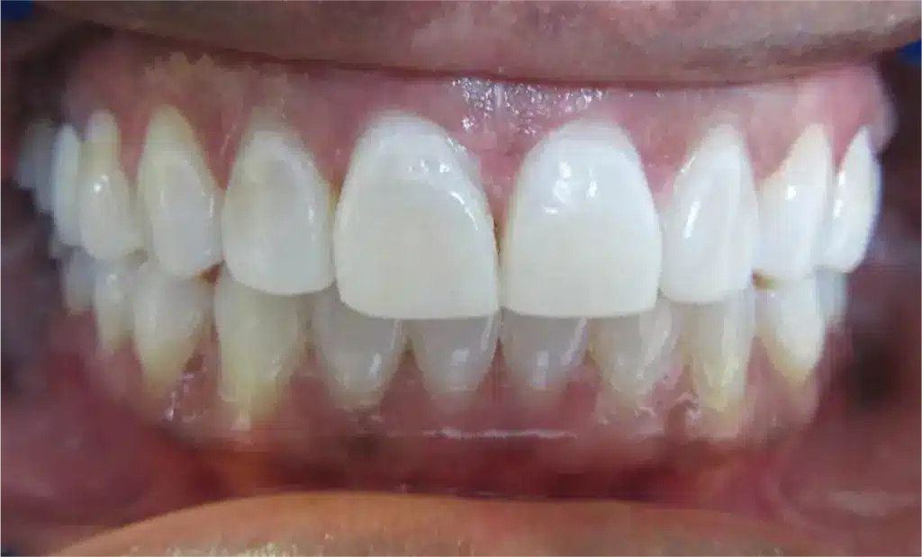 Smile Gallery. Dentist in Laguna Hills, CA. Dr. Marian Bradford, DDS. Premier Dental of South Orange County